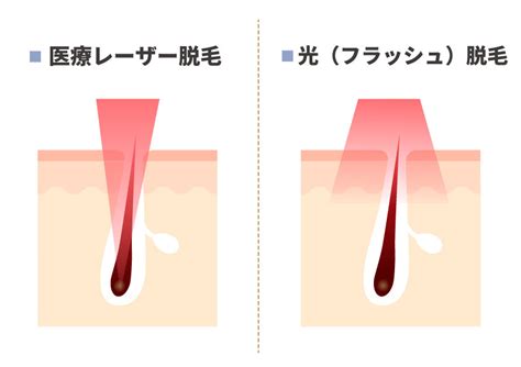 陰毛除去|陰毛は処理すべき？正しい処理方法や脱毛のメリット。